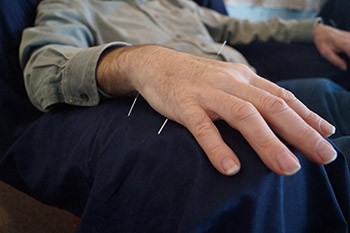 DNF Medical Centers Use Acupuncture as a Holistic Approach for Pain Management