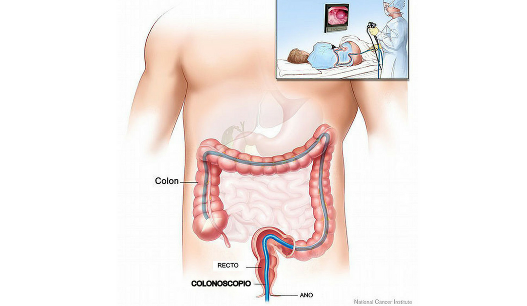 5 Reasons to Have a Colonoscopy Done