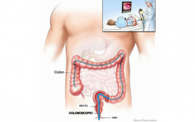 5 Reasons to Have a Colonoscopy Done